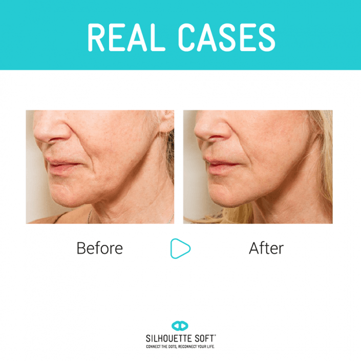 przeszczep włosów katowice, przeszczep włosów cena