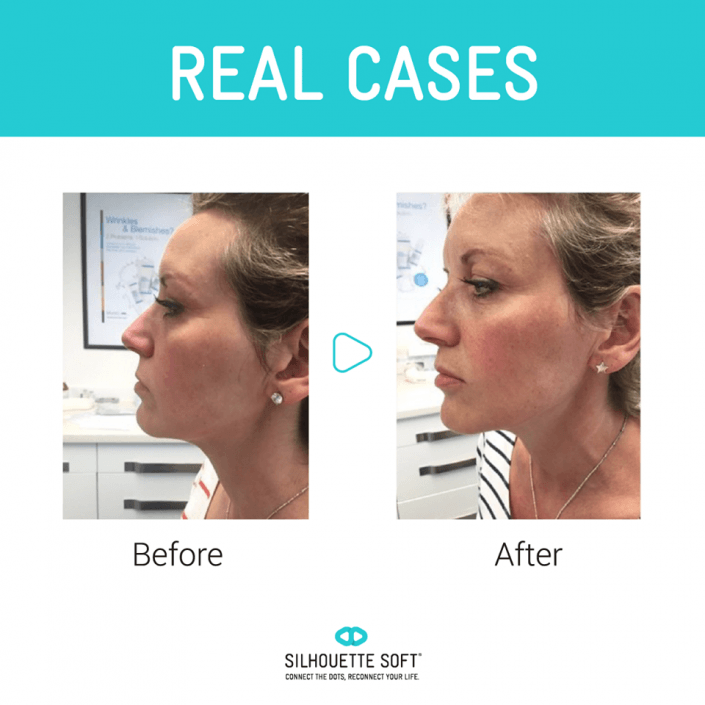 przeszczep włosów katowice, przeszczep włosów cena