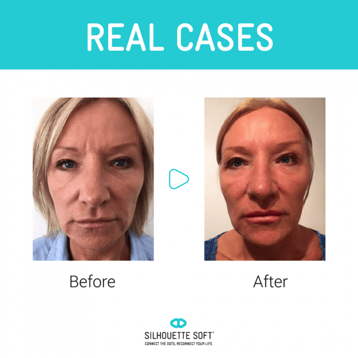 przeszczep włosów katowice, przeszczep włosów cena