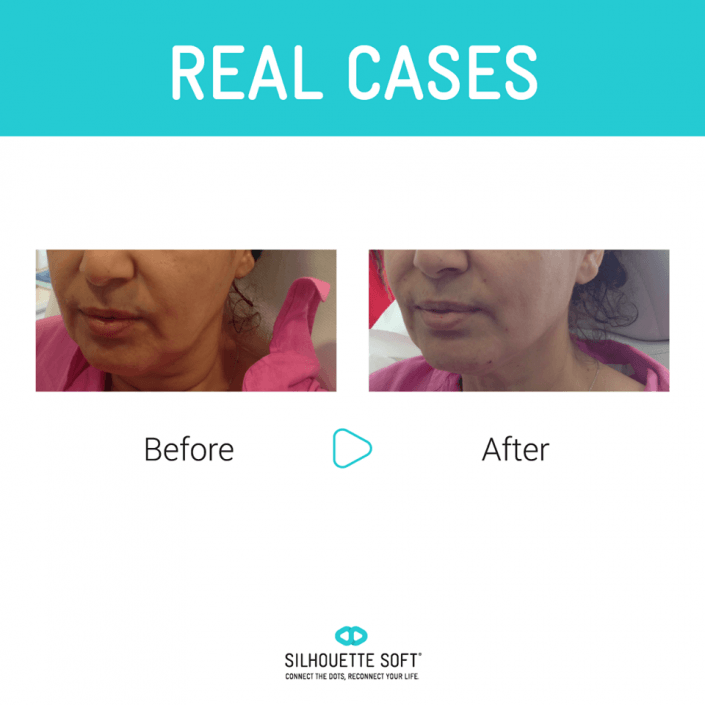 przeszczep włosów katowice, przeszczep włosów cena