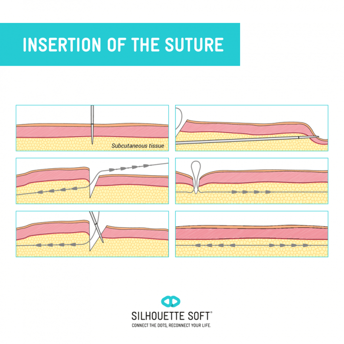 przeszczep włosów kraków, przeszczep włosów cena