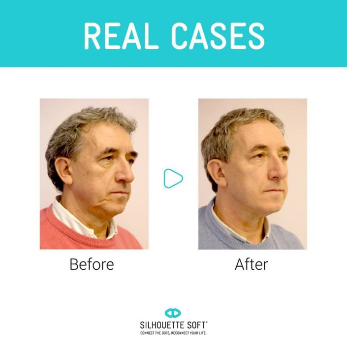 przeszczep włosów kraków, przeszczep włosów cena