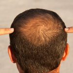 Przeszczep włosów Bielsko śląsk, przyczyny łysienia