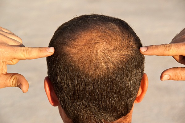 Przeszczep włosów Bielsko śląsk, przyczyny łysienia