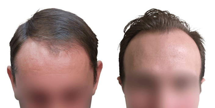 transplantacja włosów Bielsko, przeszczep włosów efekt